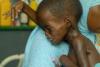 Desnutrición infantil en Somalia